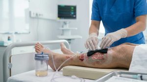 Manfaat-NPWT-untuk-Luka-Kronis